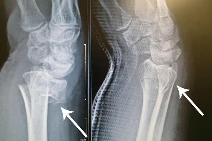 整復前後の手首骨折レントゲン画像（矢印が骨折部位）