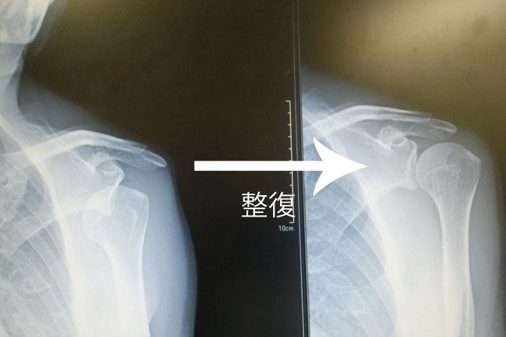 肩関節脱臼後の整復後のレントゲン画像